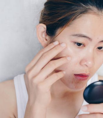 Conceptual shot of Acne & Problem Skin on female face.