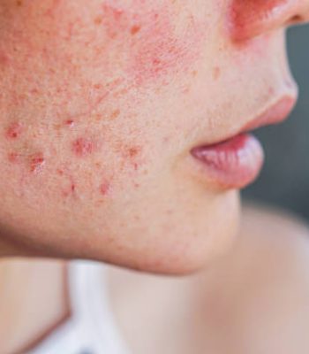 closeup acne on woman's face with rash skin ,scar and spot that allergic to cosmetics