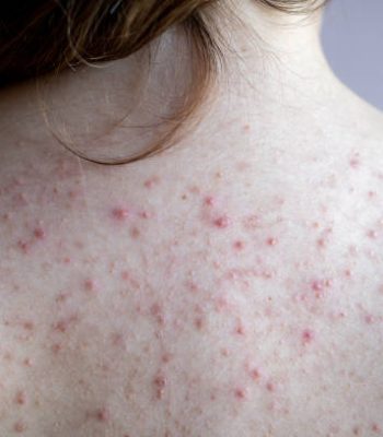 woman back with acne, red spots, skin disease. High quality photo