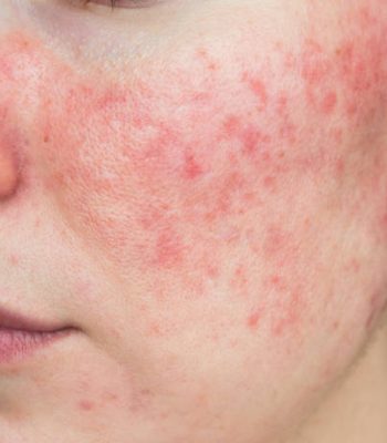 papulopustular rosacea, close-up of the patient's cheek