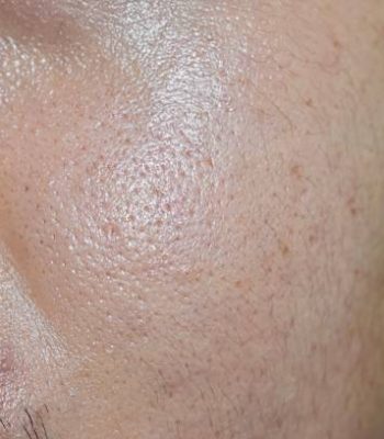 Oily and fair skin, wide pores of Southeast Asian, Myanmar or Korean adult young man. Oily skin is the result of the overproduction of sebum from sebaceous glands.