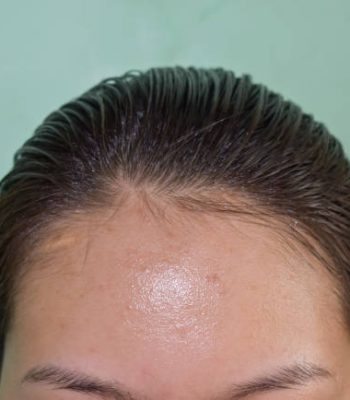 Oily skin and pimples on wide forehead of Southeast Asian, Myanmar or Korean adult young woman.
