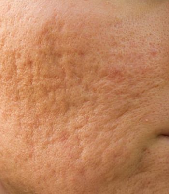 Girl with problematic skin and acne scars