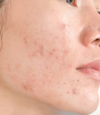 Scar from Acne on face